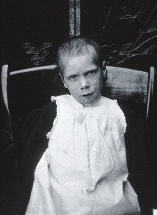 Gloucester smallpox epidemic, 1896: Edith Mills, a smallpox patient, after recovery. Photograph by H.C.F., 1896.