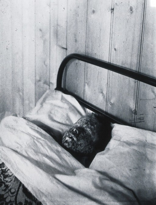 Gloucester smallpox epidemic, 1896: Kate Mills, a smallpox patient. Photograph by H.C.F., 1896.