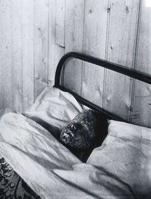 view Gloucester smallpox epidemic, 1896: Kate Mills, a smallpox patient. Photograph by H.C.F., 1896.