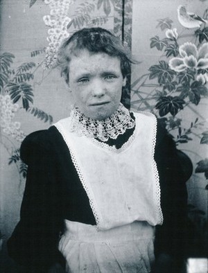 view Gloucester smallpox epidemic, 1896: Kate Mills, a smallpox patient. Photograph by H.C.F., 1896.