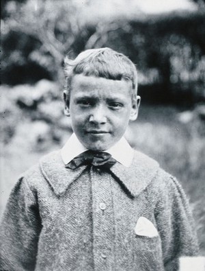 view Gloucester smallpox epidemic, 1896: J.R. Evans, aged 10 years, a smallpox patient, after recovery. Photograph by H.C.F., 1896.