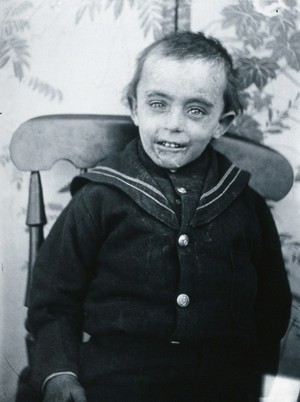 view Gloucester smallpox epidemic, 1896: a boy named Matthews, a smallpox patient. Photograph by H.C.F., 1896.