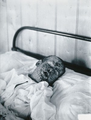 view Gloucester smallpox epidemic, 1896: Henry Wicklin, aged 6 years, as a smallpox patient. Photograph by H.C.F., 1896.