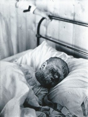 Gloucester smallpox epidemic, 1896: Mary Wicklin, aged 4 years, as a smallpox patient, a few days before her death. Photograph by H.C.F., 1896.