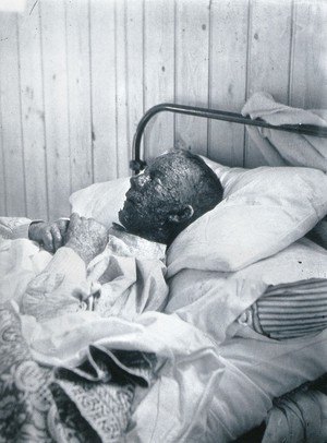 view Gloucester smallpox epidemic, 1896: Ephraim Beard, a smallpox patient. Photograph by H.C.F., 1896.