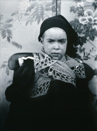Gloucester smallpox epidemic, 1896: a child of the Beard family, as a convalescent smallpox patient. Photograph by H.C.F., 1896.