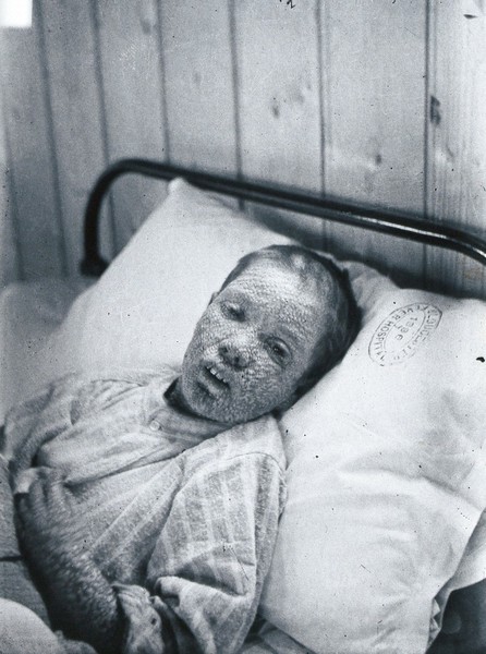 Gloucester smallpox epidemic, 1896: Ethel Cromwell, aged about 14 years, as a smallpox patient. Photograph by H.C.F., 1896.