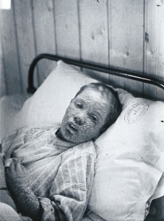 Gloucester smallpox epidemic, 1896: Ethel Cromwell, aged about 14 years, as a smallpox patient. Photograph by H.C.F., 1896.