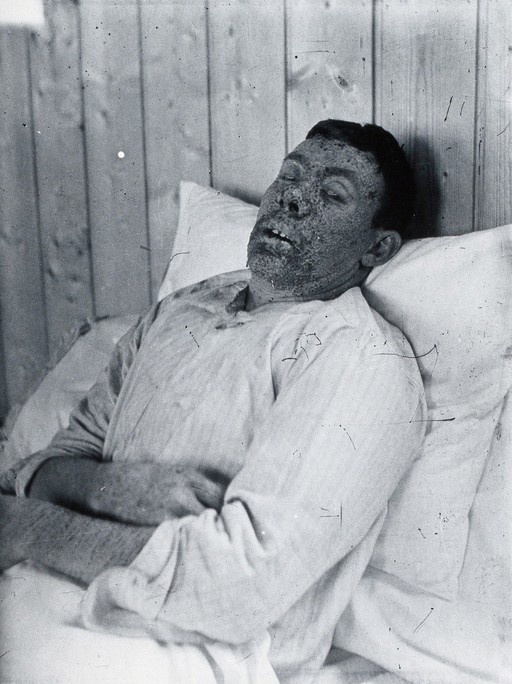 Gloucester smallpox epidemic, 1896: Mr Perks of Gloucester as a smallpox patient. Photograph by H.C.F., 1896.
