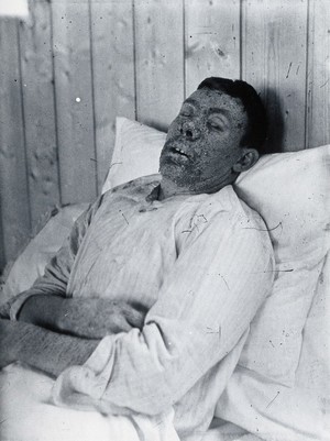 view Gloucester smallpox epidemic, 1896: Mr Perks of Gloucester as a smallpox patient. Photograph by H.C.F., 1896.