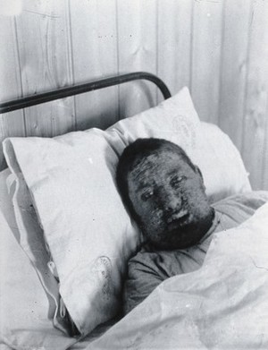 view Gloucester smallpox epidemic, 1896: Mr Worgan as a smallpox patient. Photograph by H.C.F., 1896.