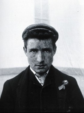 Gloucester smallpox epidemic, 1896: a young man recovering from smallpox. Photograph by H.C.F., 1896.