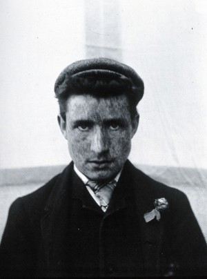 view Gloucester smallpox epidemic, 1896: a young man recovering from smallpox. Photograph by H.C.F., 1896.