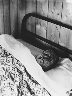 Gloucester smallpox epidemic, 1896: William Clutterbuck, a boy, recovering from smallpox. Photograph by H.C.F., 1896.