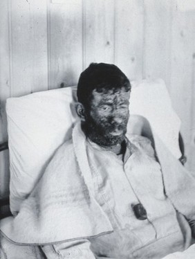 Gloucester smallpox epidemic, 1896: William Allen as a smallpox patient. Photograph by H.C.F., 1896.