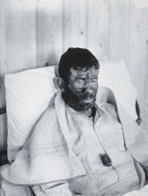 view Gloucester smallpox epidemic, 1896: William Allen as a smallpox patient. Photograph by H.C.F., 1896.