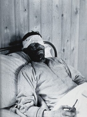 Gloucester smallpox epidemic, 1896: William Allen as a smallpox patient. Photograph by H.C.F., 1896.
