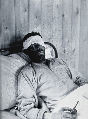 view Gloucester smallpox epidemic, 1896: William Allen as a smallpox patient. Photograph by H.C.F., 1896.