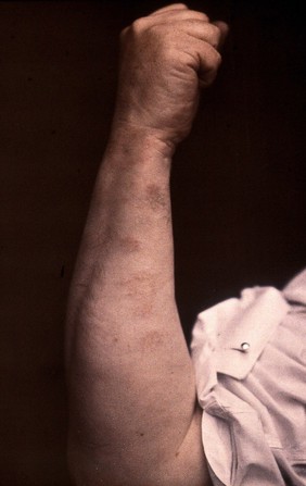 The left forearm of Sir George Turner (?), showing symptoms of leprosy. Colour photograph, 19--.