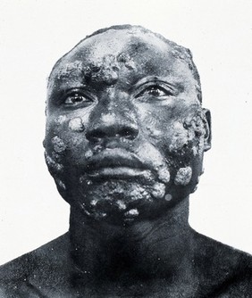 A man with yaws: head and neck. Photograph by L.W. Sambon.