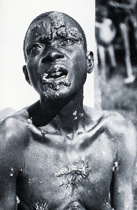 A man with yaws: head and chest. Photograph by Dr Jilkes.