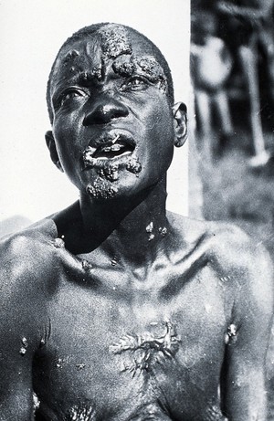 view A man with yaws: head and chest. Photograph by Dr Jilkes.