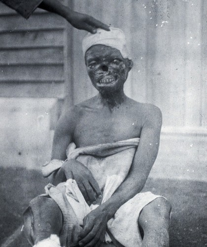 A man with yaws. Photograph by Dr Jilkes.