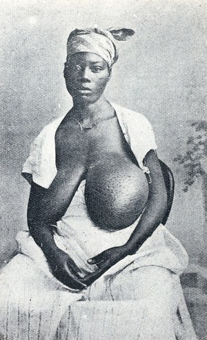 view A woman of Martinique with her left breast greatly enlarged by disease. Photograph.