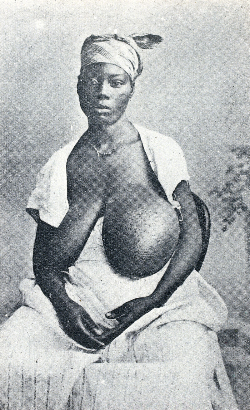 Woman with a breast enlarged by elephantiasis - Stock Image - M160/0040 -  Science Photo Library