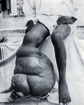 Elephantiasis in the right leg of an inhabitant of the West Indies. Photograph.