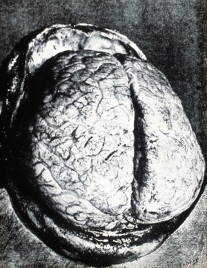 view Trypanosomiasis: the brain in sleeping sickness showing flattened convolutions. Photograph, 19--.