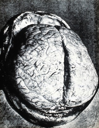 Trypanosomiasis: the brain in sleeping sickness showing flattened convolutions. Photograph, 19--.