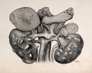 view Cystic kidneys: surgical specimen showing both kidneys, supported by renal and pelvic arteries. Watercolour by W. Thornton Shiells, 1946.