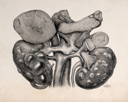 Cystic kidneys: surgical specimen showing both kidneys, supported by renal and pelvic arteries. Watercolour by W. Thornton Shiells, 1946.