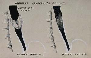 view Annular growth of gullet; left, before radium; right, after radium. Ink drawing, ca. 1930.