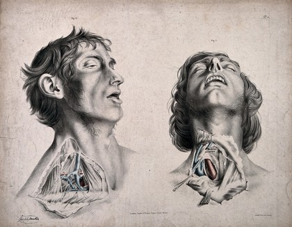 The circulatory system: two dissections of the neck of a man, with arteries, blood vessels and veins indicated in red and blue. Coloured lithograph by J. Maclise, 1841/1844.