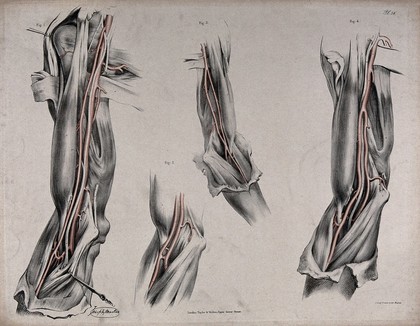 The circulatory system: dissections of the arm, shoulder and elbow, with arteries and blood vessels indicated in red. Coloured lithograph by J. Maclise, 1841/1844.