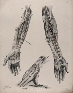 view The circulatory system: dissections of the arm and hand, with the arteries indicated in red and surgical instruments shown below. Coloured lithograph by J. Maclise, 1841/1844.