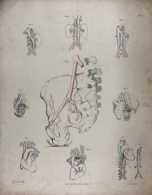 Pelvic bone: front and side views. Pencil and chalk drawing by J.  Mongrédien, ca. 1880.