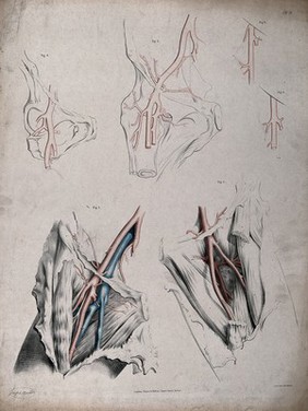 The circulatory system: dissections of the groin, thigh and hip, with the arteries and veins indicated in red and blue. Coloured lithograph by J. Maclise, 1841/1844.