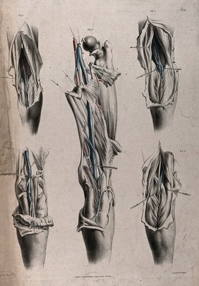 The circulatory system: dissections of the leg, with arteries and veins indicated in red and blue. Coloured lithograph by J. Maclise, 1841/1844.