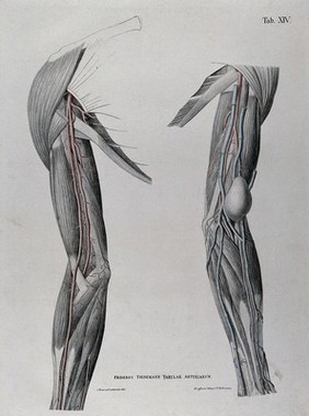 Dissections of the shoulder and arm; two figures, one showing a tumour or growth (?), with the arteries and blood vessels indicated in red. Coloured lithograph by J. Roux, 1822.