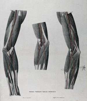 view Dissections of the arm and elbow; three figures, with the arteries and blood vessels indicated in red. Coloured lithograph by J. Roux, 1822.