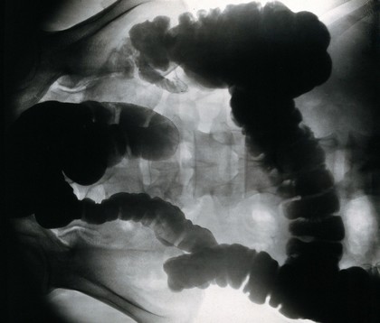 Amoebiasis: x-ray of colon. Photograph, 1930.