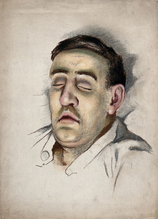 World War I: the face of a soldier suffering from the effects of phosgene gas poisoning.