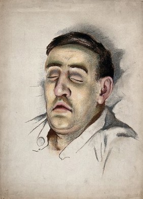 World War I: the face of a soldier suffering from the effects of phosgene gas poisoning. Pastel by A.K. Maxwell, ca. 1915.