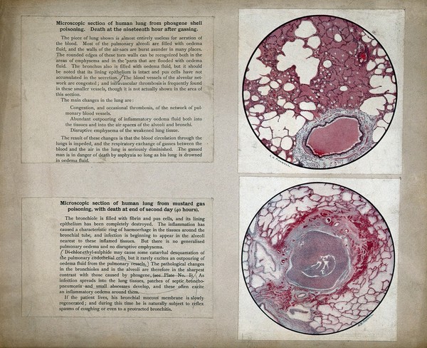 World War I: lung tissue damaged by mustard gas poisoning: microscopic section. Colour halftone after A.K. Maxwell, ca. 1917 (?).