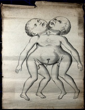 view Male conjoint twins joint at the neck and chest; anterior view. Drawing, ca. 1900.