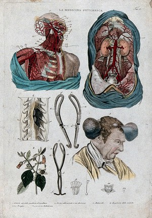 view Anatomy and botany; top left, dissected head and chest; top right, dissected thorax; centre left, forceps; centre right, man with tumours on his head; bottom left, belladona plant. Coloured engraving, 1834-1837.