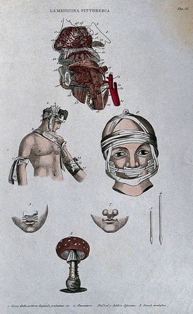 Anatomy, surgery and botany; top, dissected head showing arteries; centre, methods of bandaging the thorax and head; below, cleft lip (harelip) and instruments for surgery on  it; bottom, fly agaric mushroom. Coloured engraving, 1834-1837.